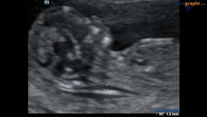Apa Itu Nt Scan Atau Nuchal Translucency Scan Ultrasound Scan Bangi Putrajaya Kajang